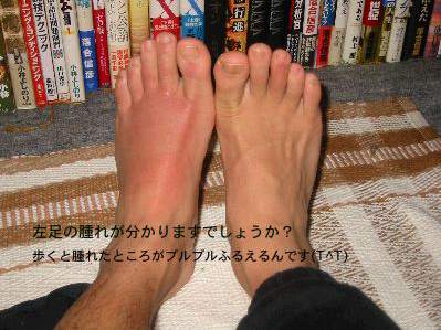 更に腫れた足
